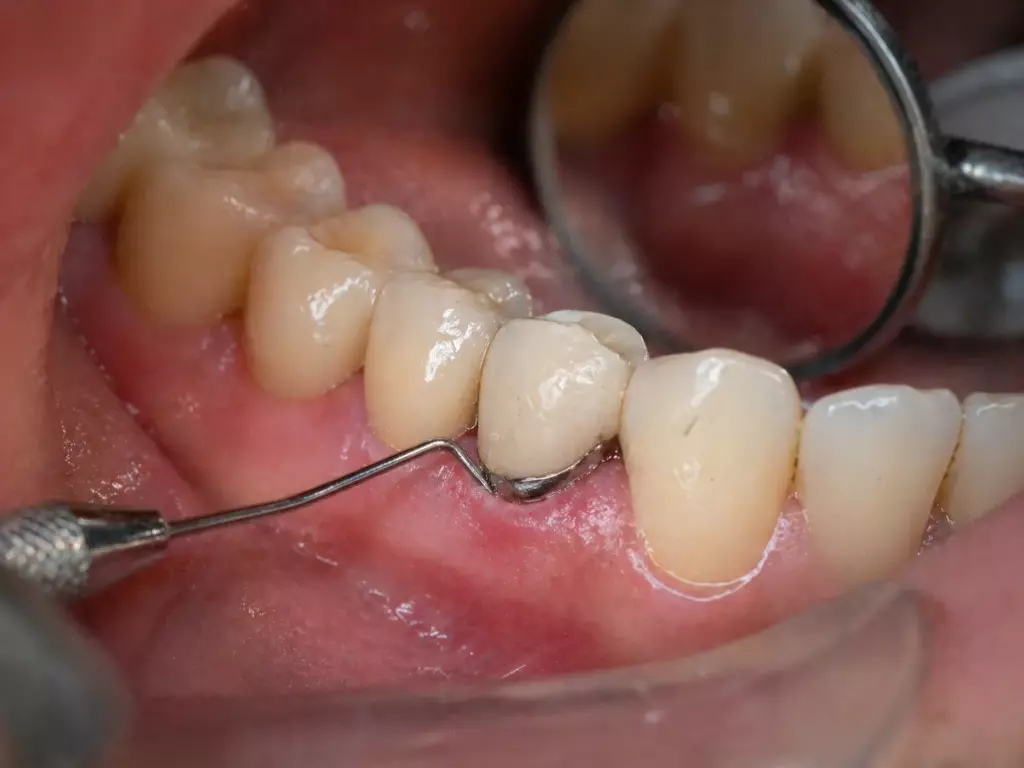 Коронка шатается: причины и как спасти - Vivadent