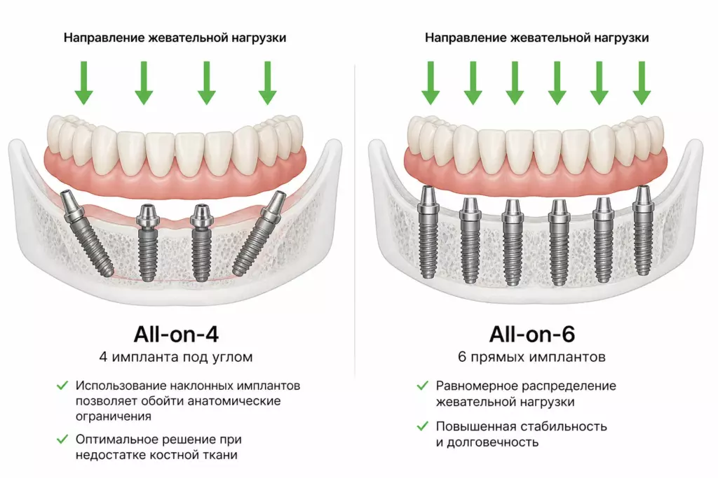 Имплантация all-on-6: плюсы и минусы от стоматолога - Vivadent
