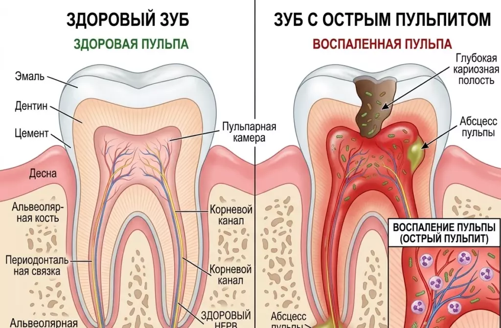 Виды пульпита: острый, хронический, гипертрофический — как их отличить - Vivadent